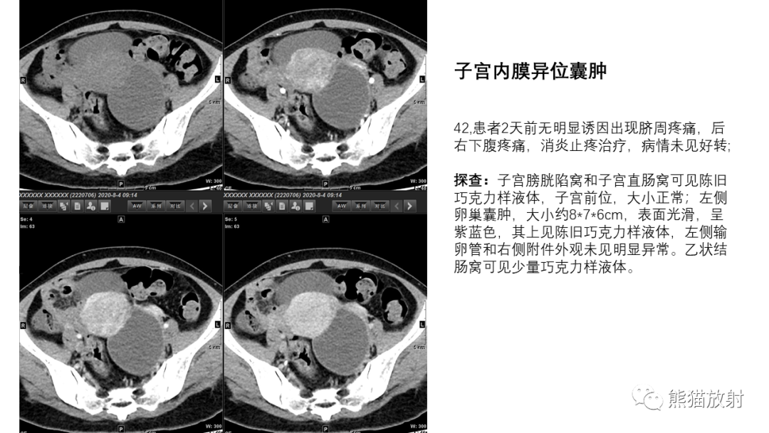 影像PPT - 【PPT】卵巢粘液性囊腺瘤 VS 浆液性囊腺瘤-44