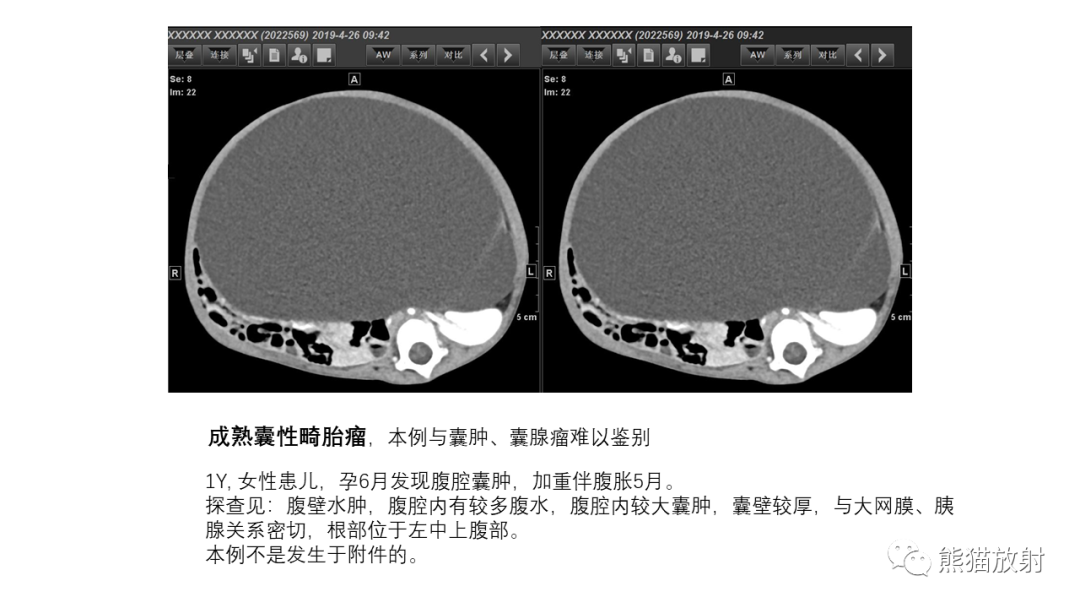 影像PPT - 【PPT】卵巢粘液性囊腺瘤 VS 浆液性囊腺瘤-47