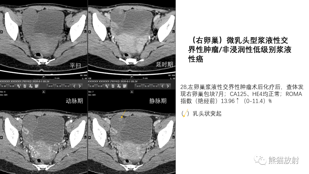 影像PPT - 【PPT】卵巢粘液性囊腺瘤 VS 浆液性囊腺瘤-49