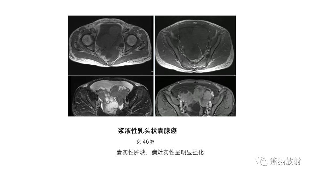 影像PPT - 【PPT】卵巢粘液性囊腺瘤 VS 浆液性囊腺瘤-50