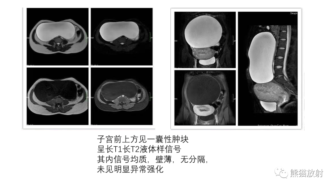 影像PPT - 【PPT】卵巢粘液性囊腺瘤 VS 浆液性囊腺瘤-52
