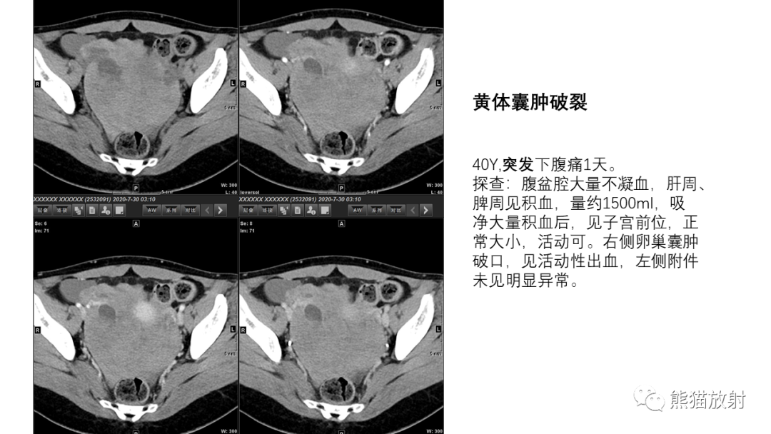 影像PPT - 【PPT】卵巢粘液性囊腺瘤 VS 浆液性囊腺瘤-53