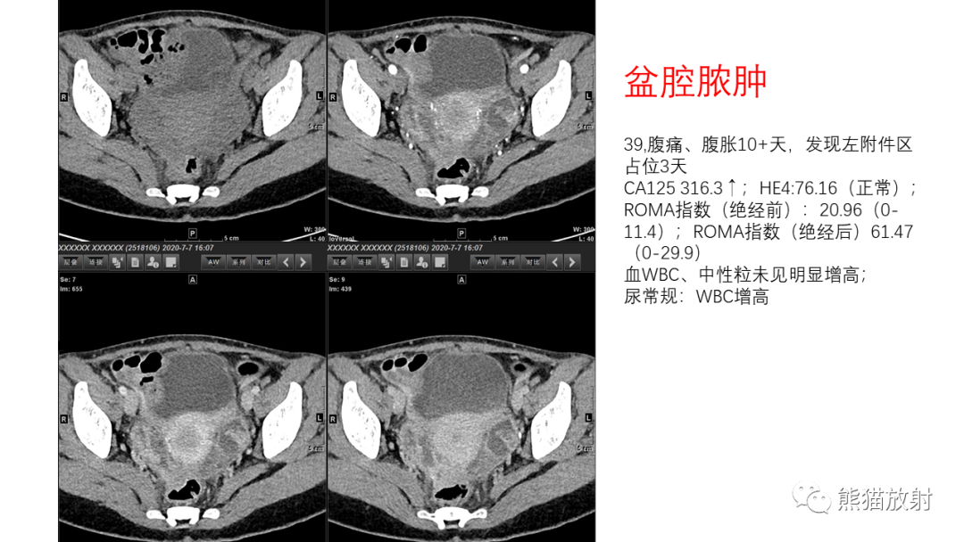 影像PPT - 【PPT】卵巢粘液性囊腺瘤 VS 浆液性囊腺瘤-55