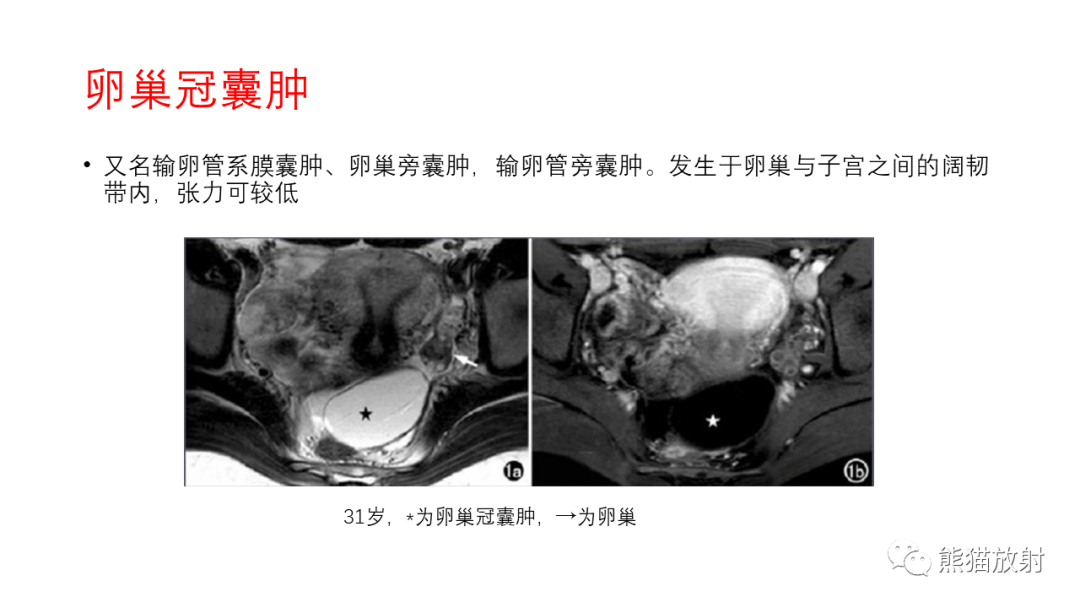 影像PPT - 【PPT】卵巢粘液性囊腺瘤 VS 浆液性囊腺瘤-54