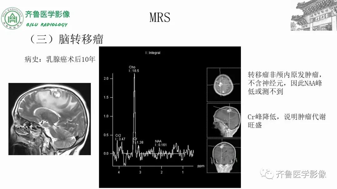 影像PPT - 【PPT】磁共振波谱MRS-17