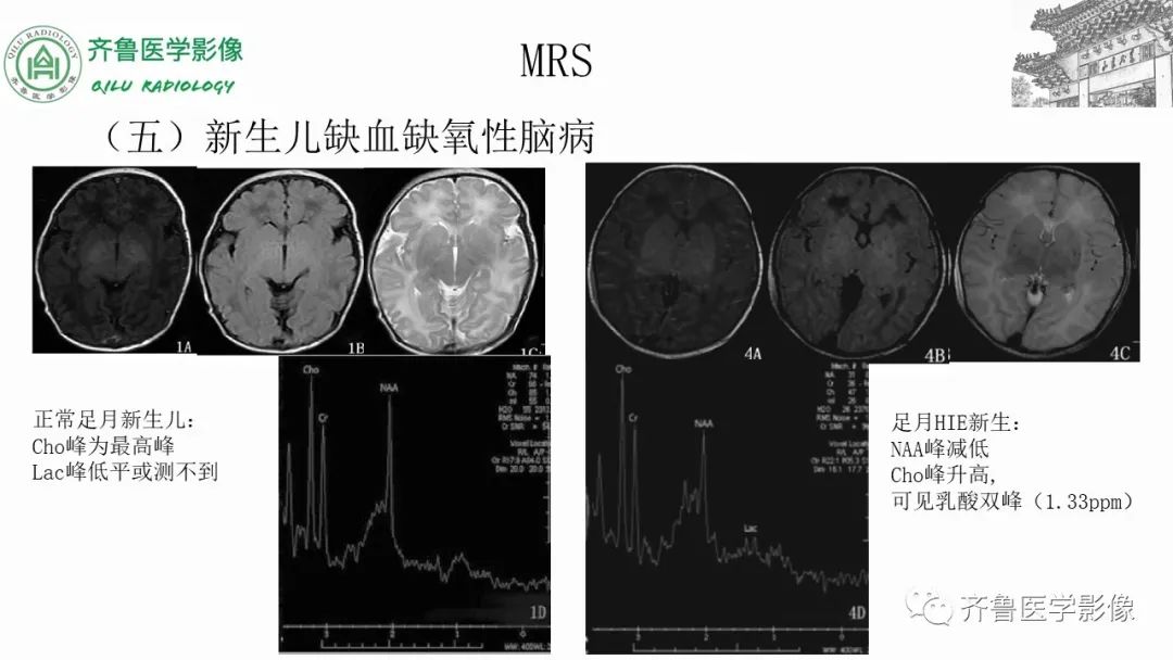 影像PPT - 【PPT】磁共振波谱MRS-19