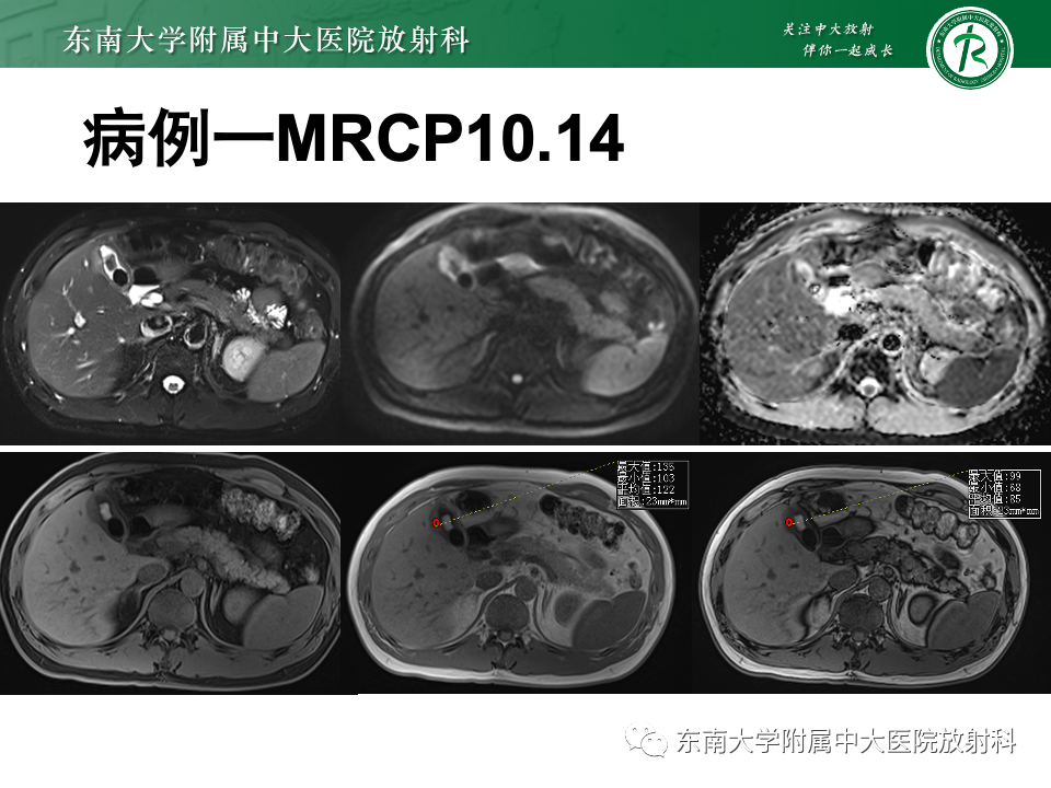 影像PPT - 【PPT】胆囊壁增厚性疾病的影像诊断思路-10 影像PPT - 【PPT】胆囊壁增厚性疾病的影像诊断思路-10