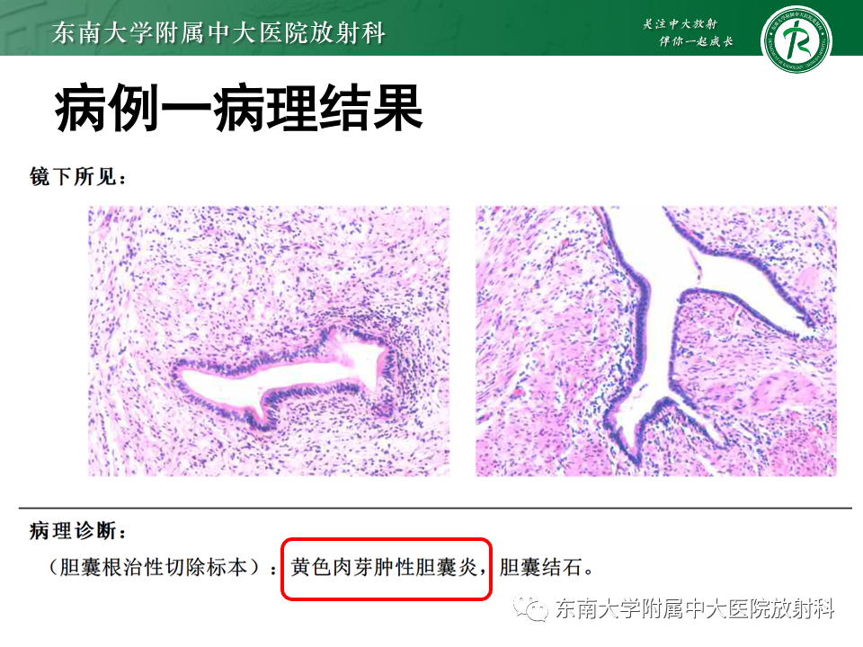 影像PPT - 【PPT】胆囊壁增厚性疾病的影像诊断思路-12 影像PPT - 【PPT】胆囊壁增厚性疾病的影像诊断思路-12