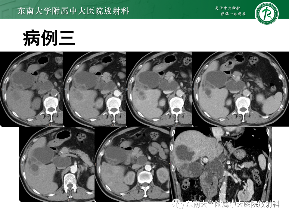 影像PPT - 【PPT】胆囊壁增厚性疾病的影像诊断思路-16 影像PPT - 【PPT】胆囊壁增厚性疾病的影像诊断思路-16