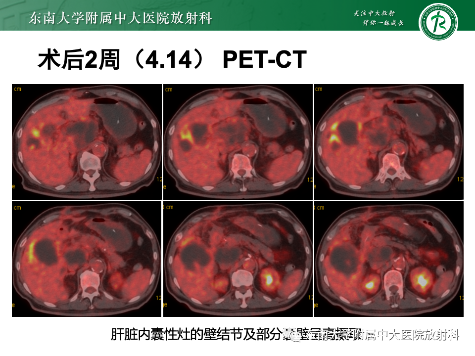 影像PPT - 【PPT】胆囊壁增厚性疾病的影像诊断思路-19 影像PPT - 【PPT】胆囊壁增厚性疾病的影像诊断思路-19