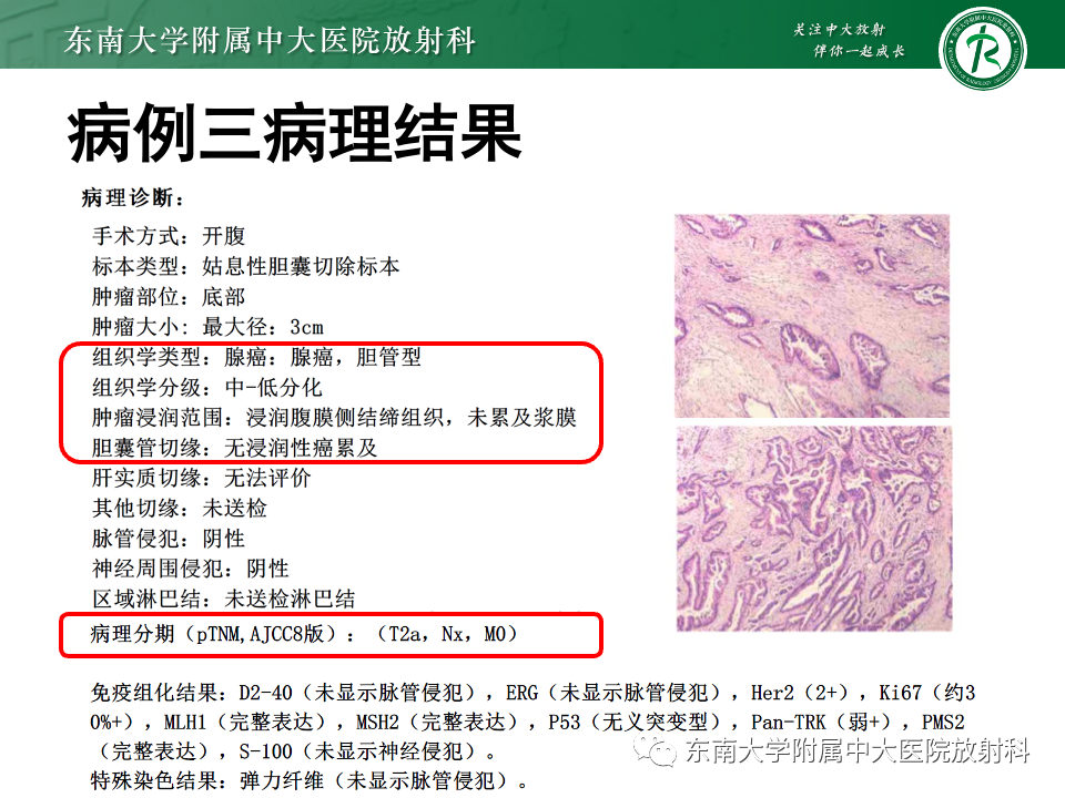 影像PPT - 【PPT】胆囊壁增厚性疾病的影像诊断思路-18 影像PPT - 【PPT】胆囊壁增厚性疾病的影像诊断思路-18