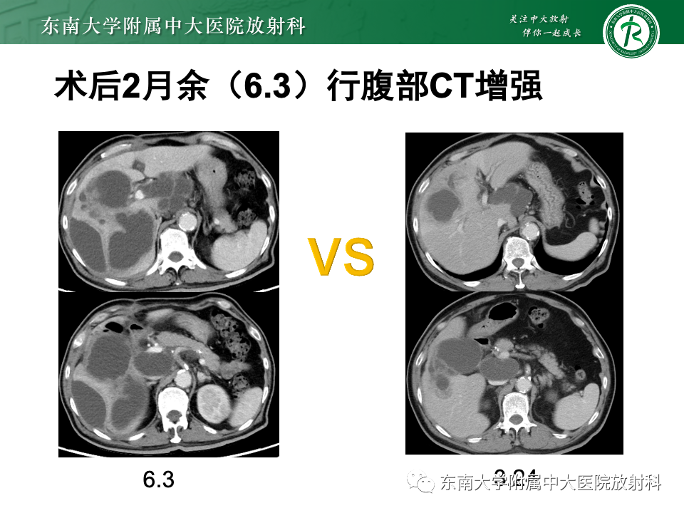 影像PPT - 【PPT】胆囊壁增厚性疾病的影像诊断思路-21 影像PPT - 【PPT】胆囊壁增厚性疾病的影像诊断思路-21