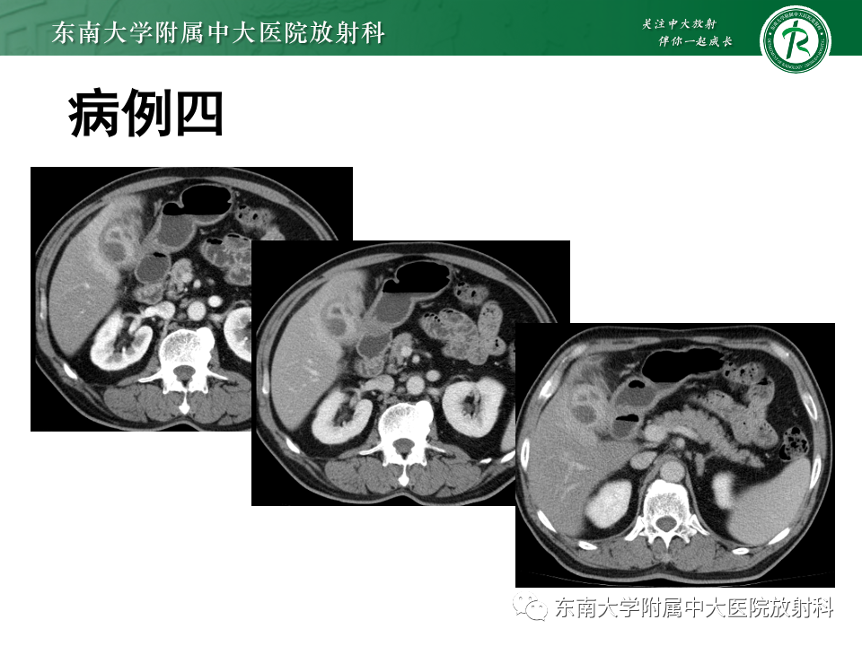 影像PPT - 【PPT】胆囊壁增厚性疾病的影像诊断思路-22 影像PPT - 【PPT】胆囊壁增厚性疾病的影像诊断思路-22