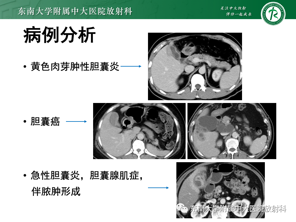 影像PPT - 【PPT】胆囊壁增厚性疾病的影像诊断思路-25 影像PPT - 【PPT】胆囊壁增厚性疾病的影像诊断思路-25