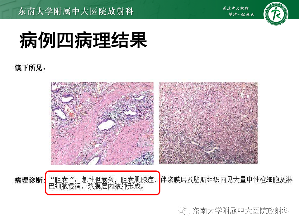 影像PPT - 【PPT】胆囊壁增厚性疾病的影像诊断思路-24 影像PPT - 【PPT】胆囊壁增厚性疾病的影像诊断思路-24