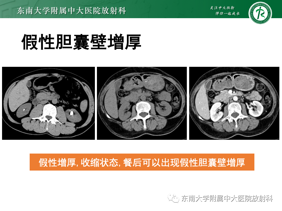 影像PPT - 【PPT】胆囊壁增厚性疾病的影像诊断思路-31 影像PPT - 【PPT】胆囊壁增厚性疾病的影像诊断思路-31