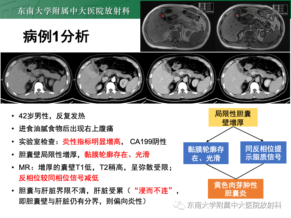 影像PPT - 【PPT】胆囊壁增厚性疾病的影像诊断思路-35 影像PPT - 【PPT】胆囊壁增厚性疾病的影像诊断思路-35