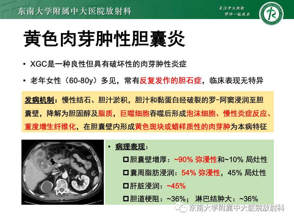影像PPT - 【PPT】胆囊壁增厚性疾病的影像诊断思路-36 影像PPT - 【PPT】胆囊壁增厚性疾病的影像诊断思路-36