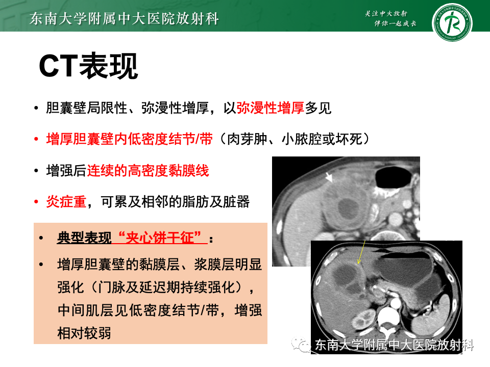 影像PPT - 【PPT】胆囊壁增厚性疾病的影像诊断思路-37 影像PPT - 【PPT】胆囊壁增厚性疾病的影像诊断思路-37