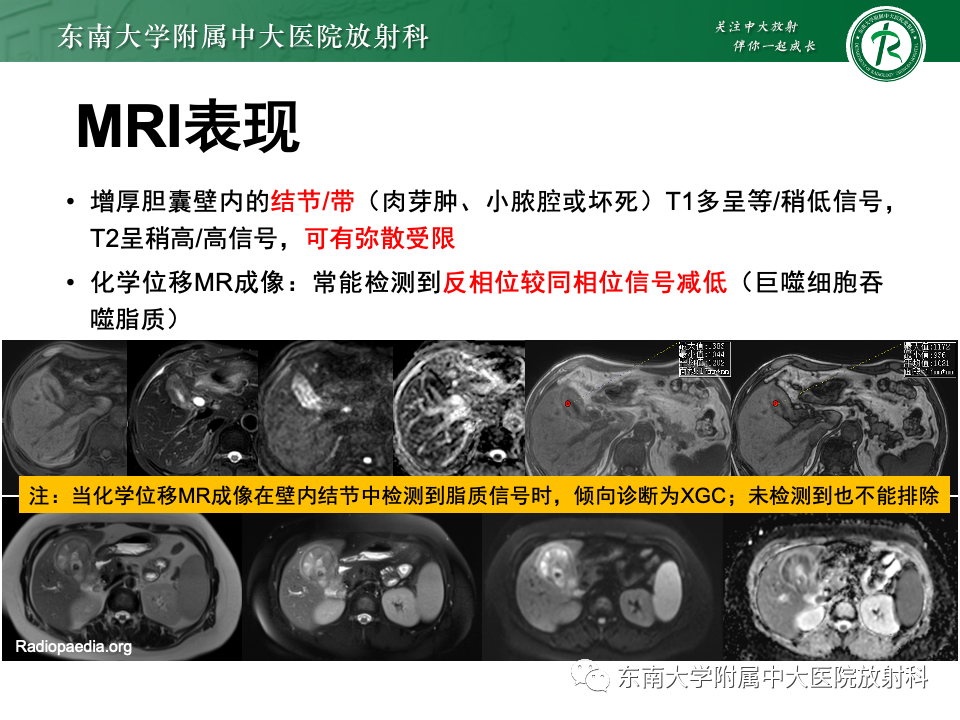 影像PPT - 【PPT】胆囊壁增厚性疾病的影像诊断思路-38 影像PPT - 【PPT】胆囊壁增厚性疾病的影像诊断思路-38