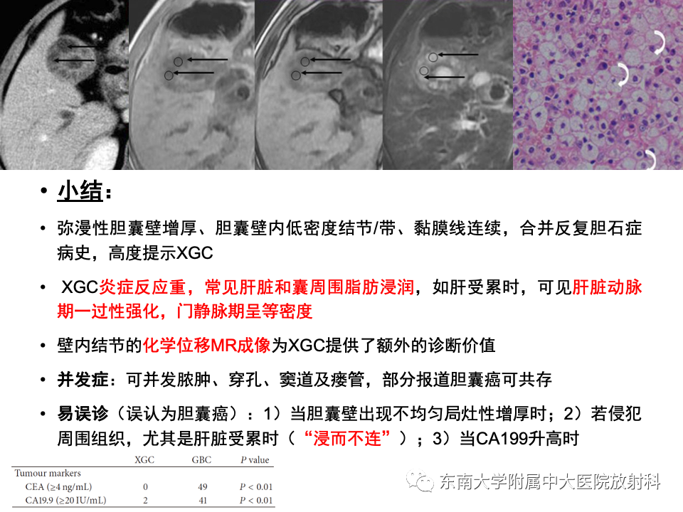 影像PPT - 【PPT】胆囊壁增厚性疾病的影像诊断思路-39 影像PPT - 【PPT】胆囊壁增厚性疾病的影像诊断思路-39