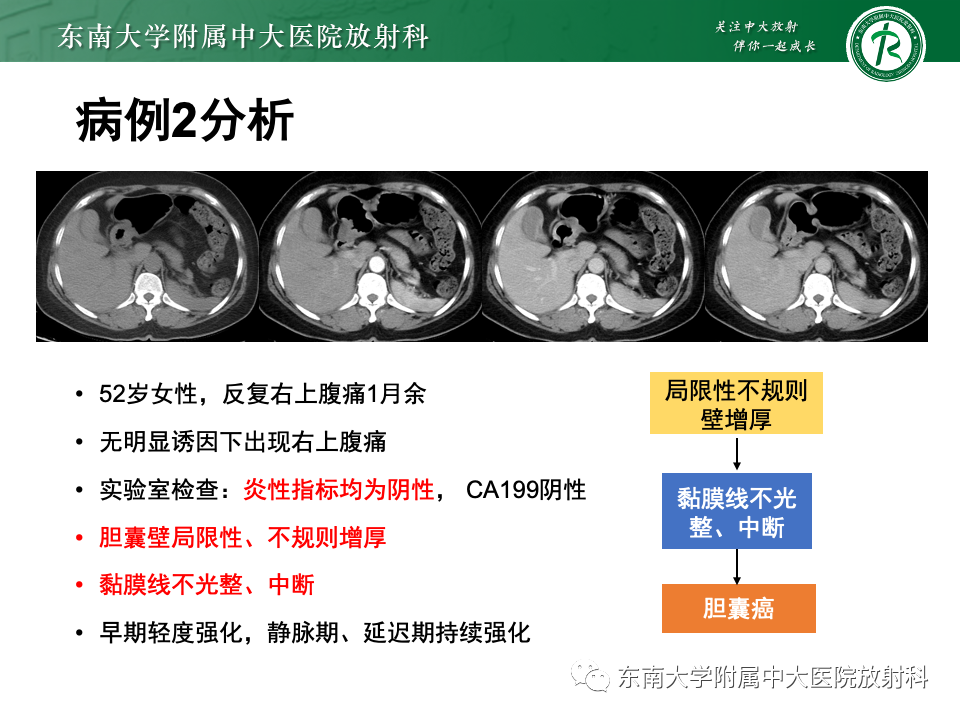 影像PPT - 【PPT】胆囊壁增厚性疾病的影像诊断思路-40 影像PPT - 【PPT】胆囊壁增厚性疾病的影像诊断思路-40