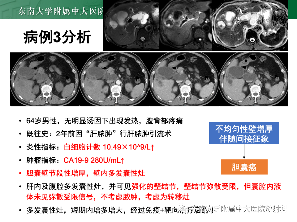 影像PPT - 【PPT】胆囊壁增厚性疾病的影像诊断思路-41 影像PPT - 【PPT】胆囊壁增厚性疾病的影像诊断思路-41