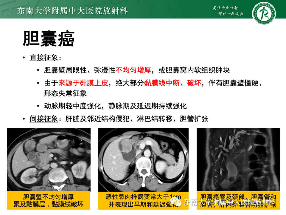 影像PPT - 【PPT】胆囊壁增厚性疾病的影像诊断思路-43 影像PPT - 【PPT】胆囊壁增厚性疾病的影像诊断思路-43