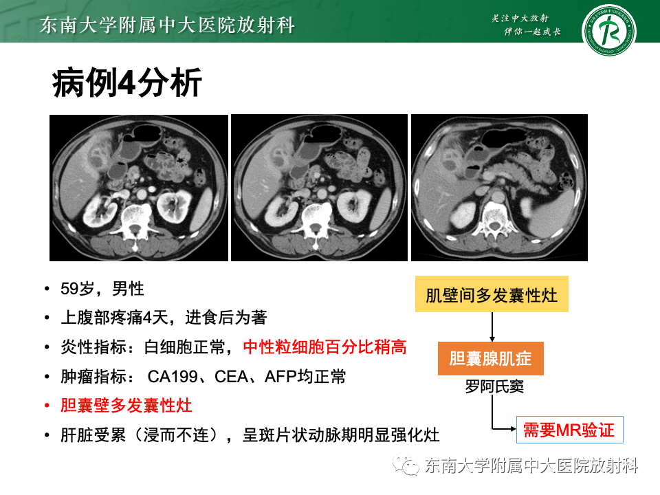 影像PPT - 【PPT】胆囊壁增厚性疾病的影像诊断思路-45 影像PPT - 【PPT】胆囊壁增厚性疾病的影像诊断思路-45