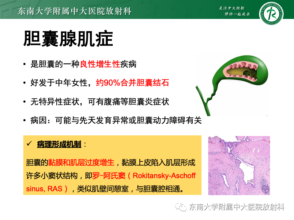 影像PPT - 【PPT】胆囊壁增厚性疾病的影像诊断思路-46 影像PPT - 【PPT】胆囊壁增厚性疾病的影像诊断思路-46