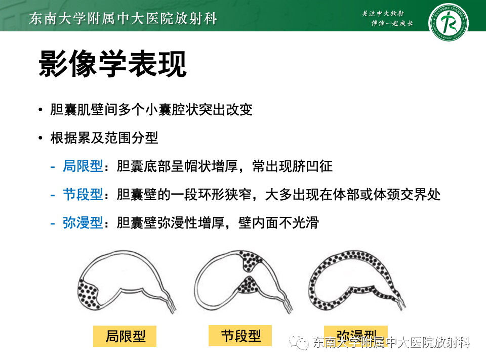 影像PPT - 【PPT】胆囊壁增厚性疾病的影像诊断思路-47 影像PPT - 【PPT】胆囊壁增厚性疾病的影像诊断思路-47