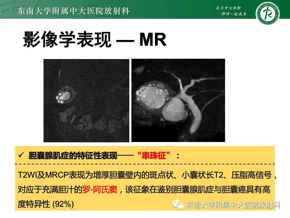 影像PPT - 【PPT】胆囊壁增厚性疾病的影像诊断思路-49 影像PPT - 【PPT】胆囊壁增厚性疾病的影像诊断思路-49