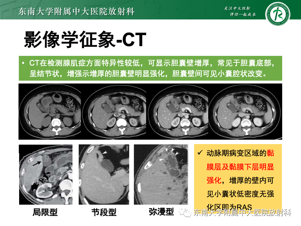 影像PPT - 【PPT】胆囊壁增厚性疾病的影像诊断思路-48 影像PPT - 【PPT】胆囊壁增厚性疾病的影像诊断思路-48