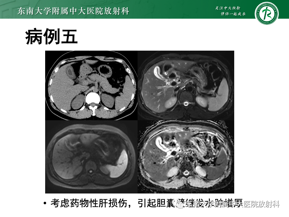 影像PPT - 【PPT】胆囊壁增厚性疾病的影像诊断思路-53 影像PPT - 【PPT】胆囊壁增厚性疾病的影像诊断思路-53