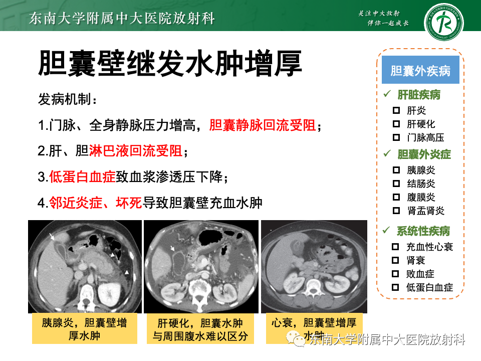 影像PPT - 【PPT】胆囊壁增厚性疾病的影像诊断思路-54 影像PPT - 【PPT】胆囊壁增厚性疾病的影像诊断思路-54