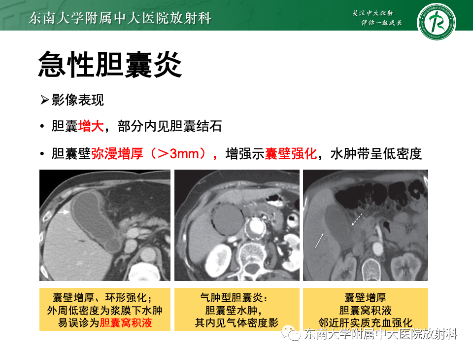 影像PPT - 【PPT】胆囊壁增厚性疾病的影像诊断思路-58 影像PPT - 【PPT】胆囊壁增厚性疾病的影像诊断思路-58