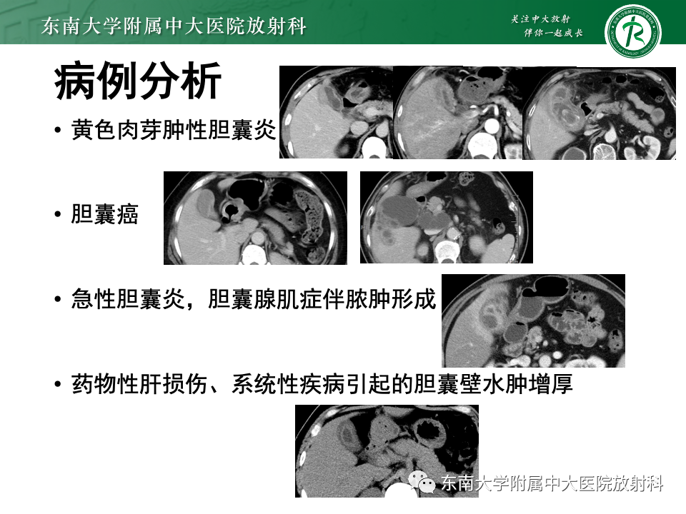 影像PPT - 【PPT】胆囊壁增厚性疾病的影像诊断思路-55 影像PPT - 【PPT】胆囊壁增厚性疾病的影像诊断思路-55