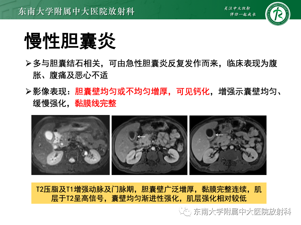 影像PPT - 【PPT】胆囊壁增厚性疾病的影像诊断思路-59 影像PPT - 【PPT】胆囊壁增厚性疾病的影像诊断思路-59