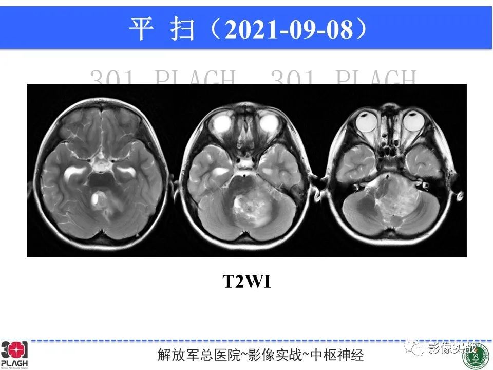 影像PPT - 【病例】幕下室管膜瘤1例MR影像诊断思路-5