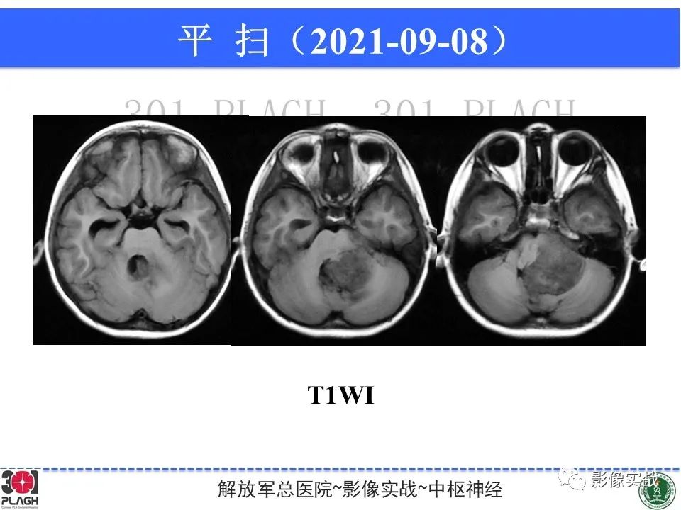 影像PPT - 【病例】幕下室管膜瘤1例MR影像诊断思路-6