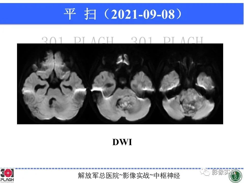 影像PPT - 【病例】幕下室管膜瘤1例MR影像诊断思路-7