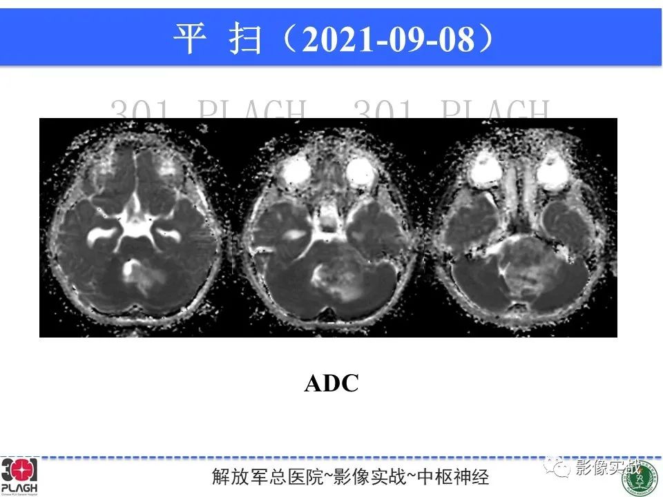 影像PPT - 【病例】幕下室管膜瘤1例MR影像诊断思路-8
