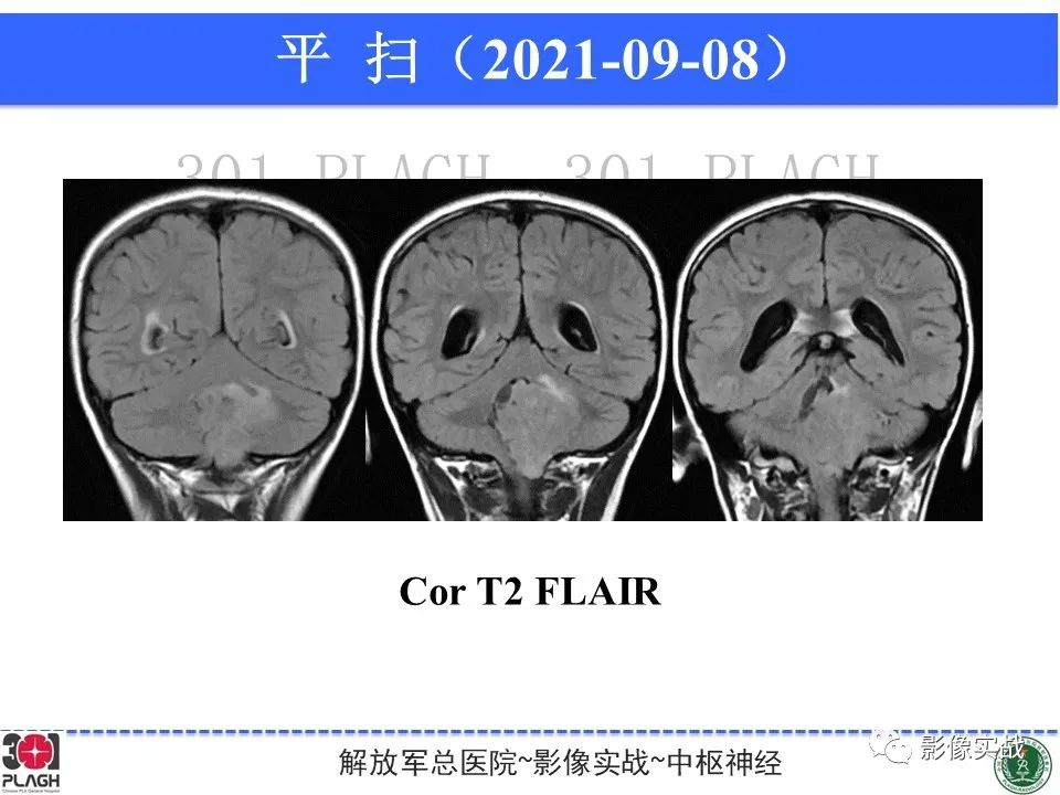 影像PPT - 【病例】幕下室管膜瘤1例MR影像诊断思路-9