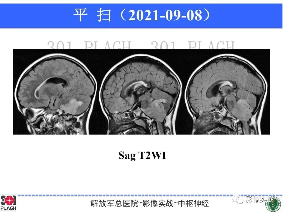 影像PPT - 【病例】幕下室管膜瘤1例MR影像诊断思路-10