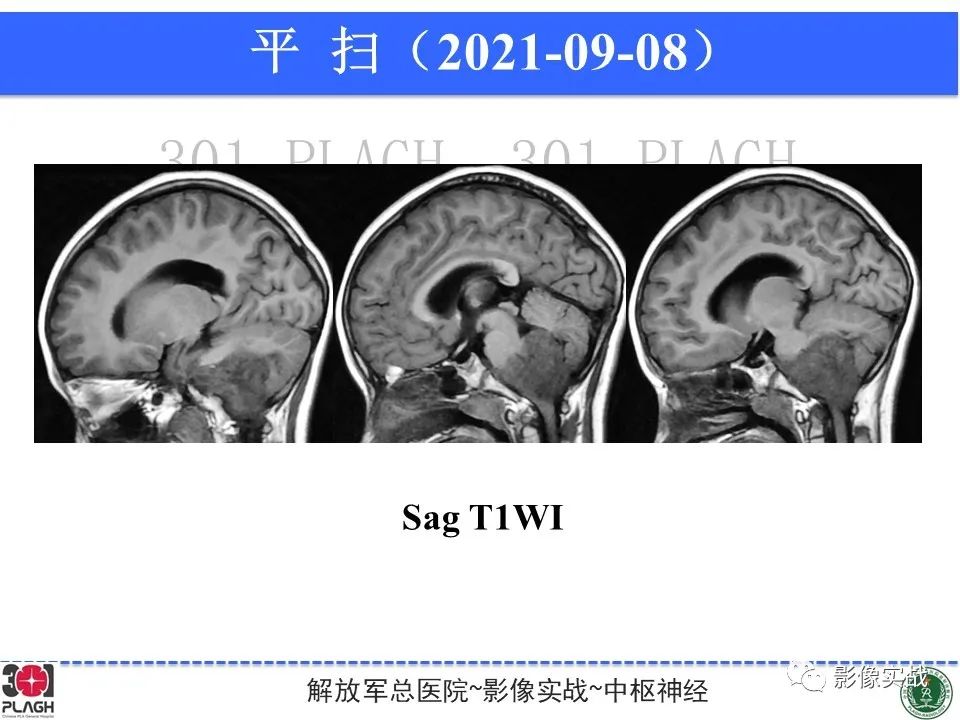 影像PPT - 【病例】幕下室管膜瘤1例MR影像诊断思路-11