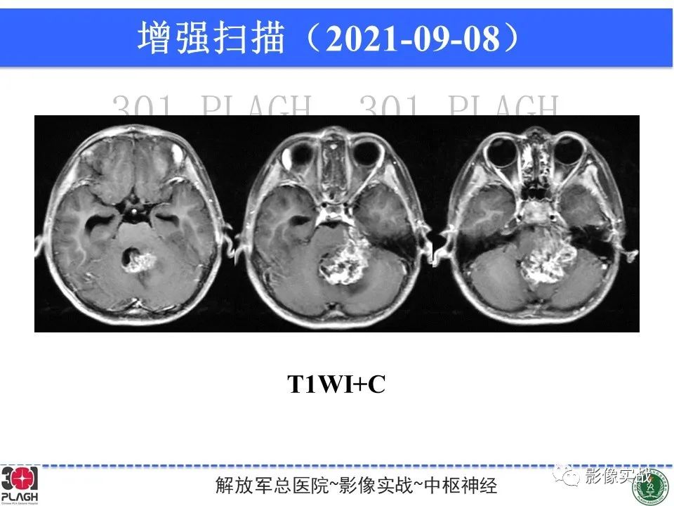 影像PPT - 【病例】幕下室管膜瘤1例MR影像诊断思路-12