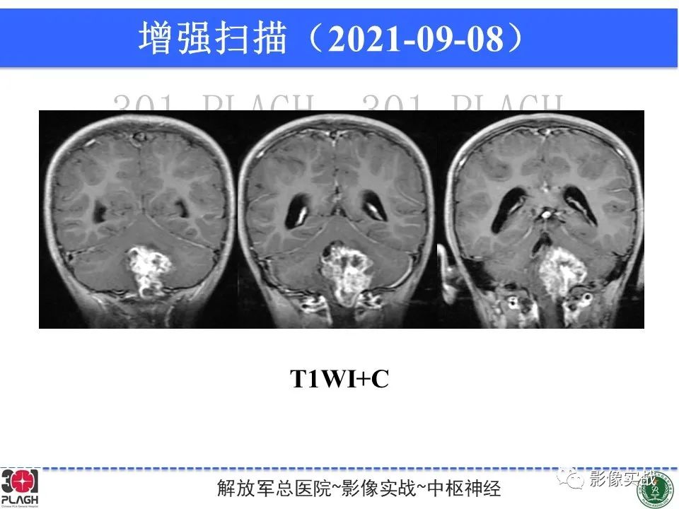 影像PPT - 【病例】幕下室管膜瘤1例MR影像诊断思路-13
