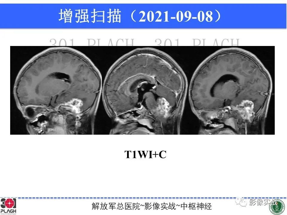 影像PPT - 【病例】幕下室管膜瘤1例MR影像诊断思路-14