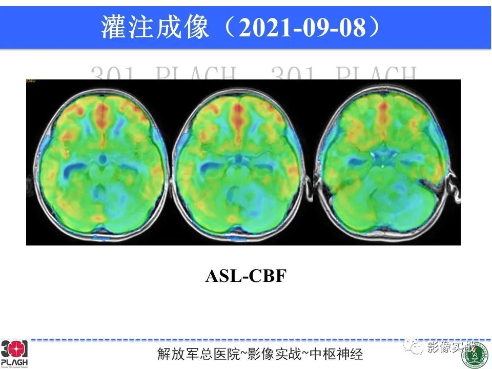 影像PPT - 【病例】幕下室管膜瘤1例MR影像诊断思路-15