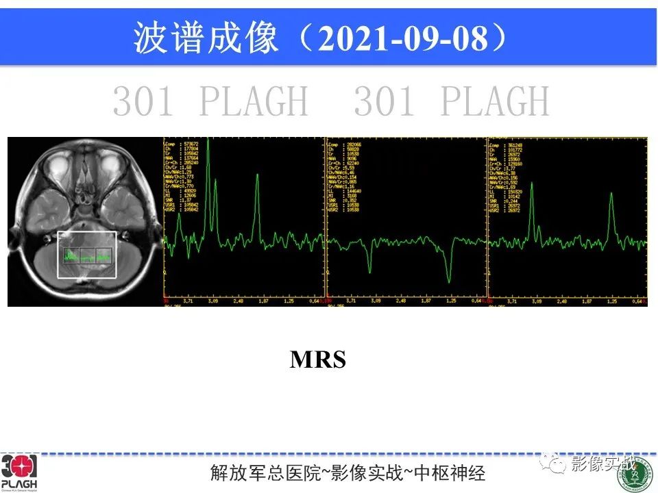 影像PPT - 【病例】幕下室管膜瘤1例MR影像诊断思路-16